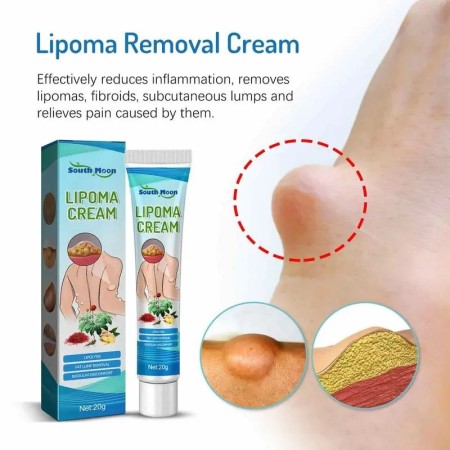 Lipoma Treatment Ointment